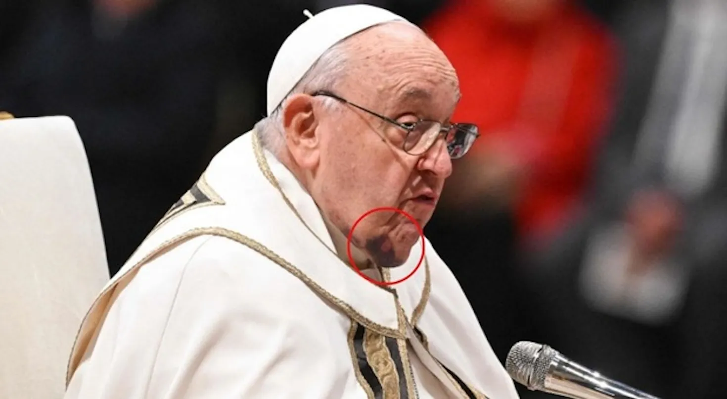 Shock a San Pietro: Papa Francesco con un ematoma sotto al mento!